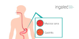 gastritis crónica