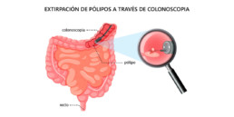 polipos colon