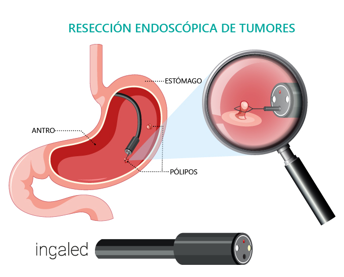 resección endoscópica de tumores